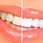 Dental White Strips – мнения – форум – отзиви – коментари – бг мама