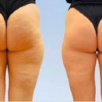 Cellulite Massage – форум – отзиви – коментари – бг мама – мнения