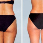 Cellulite Massage – цена