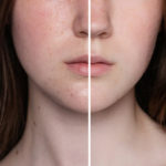 Revamin Acne Cream – състав